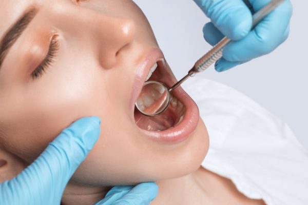 dental fillings